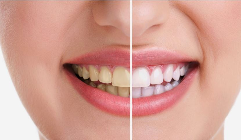 दाँतको पहेंलोपन हटाउन के गर्ने ? यस्ता छन् प्राकृतिक उपाय